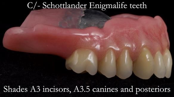 Newsletter 54 case presentation upper complete denture and lower Scandinavian designed hygienic partial denture for David