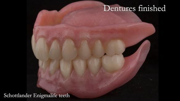 Newsletter 75: Marion’s case - Step-by-step complete denture workflow