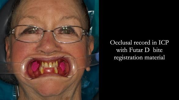 Finlay's Case Study Newsletter 40 - Immediate Mk 1 RPD to Definitive Mk 2 RPD - full protocol