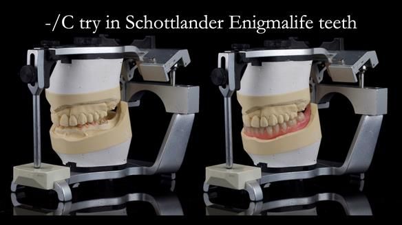 Newsletter 44 - extreme removable prosthodontics – engineering a super-strong and ultra-thin over denture