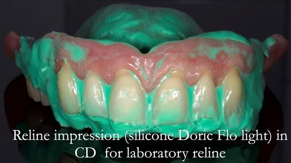 Finlay's Newsletter 62 provision of extractions and metal based complete dentures for Rafique