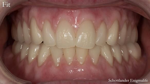Newsletter 75: Marion’s case - Step-by-step complete denture workflow