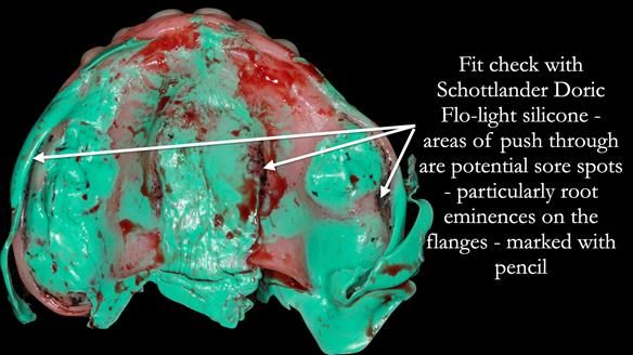 Newsletter 52 Managing Jo’s failing dentition with extractions and Mk 1/Mk 2 complete upper dentures and lower partial dentures FULL PROTOCOL