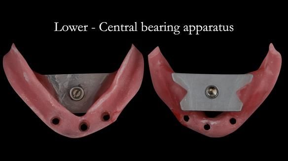 This fits over the implants and onto the denture supporting soft tissues accurately