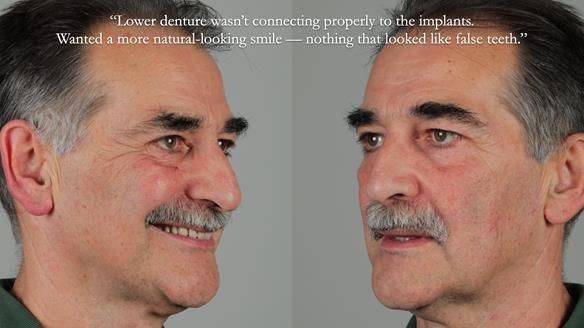 Newsletter 78: What do Clark Gable and a Locator® overdenture have in common?