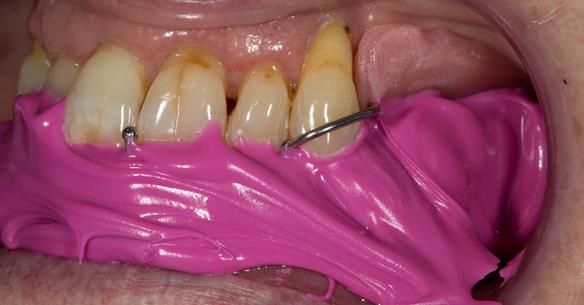 Figure 25 Inter-maxillary registration with central bearing apparatus in the mouth with the maxillary and mandibular parts registered together with futar D bite registration material