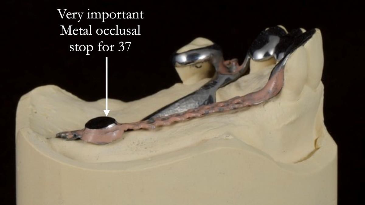 Newsletter 89 – Simon: A Challenging Kennedy Class II Division 1 Upper CoCr Partial Denture with a High Smile Line