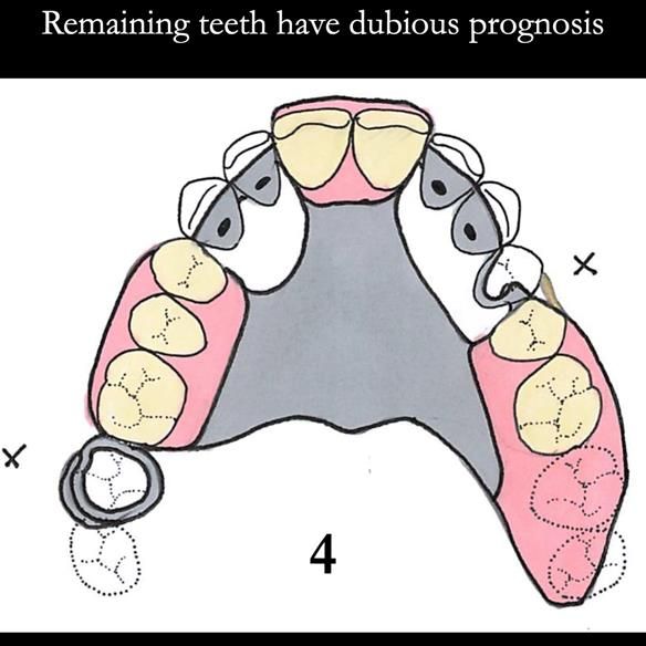 Universal Scandinavian partial denture designs