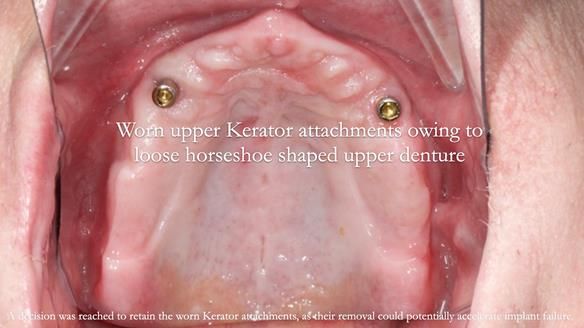 Newsletter 57 showcases the making and fitting process of implant-supported complete dentures for Alisdair