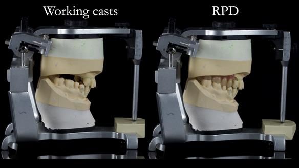 Newsletter 56 showing the making and fitting of a bilateral free end saddle upper removable partial denture (RPD) for patient with pemphigus
