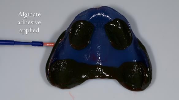 Newsletter 80 - Gordon’s dentures: the one case in 1,000 where my technique failed