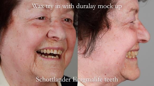 Finlay's Newsletter 60 Sylvia's upper Kennedy Class 2 Mod 1 metal based upper RPD