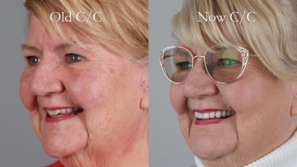 Replacing Madeline’s Complete denture FULL PROTOCOL