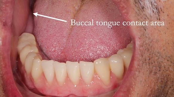 Finlay's Newsletter 62 provision of extractions and metal based complete dentures for Rafique