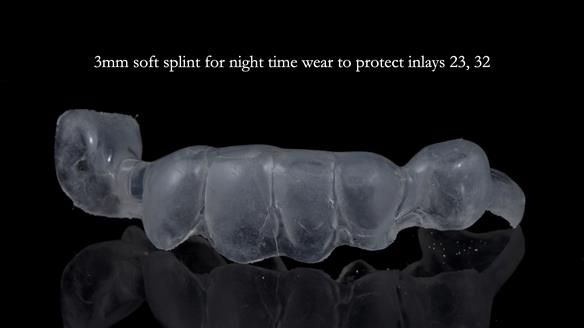 Newsletter 55 Provision of metal based partial dentures for Zephyrine with a repaired cleft lip and palate