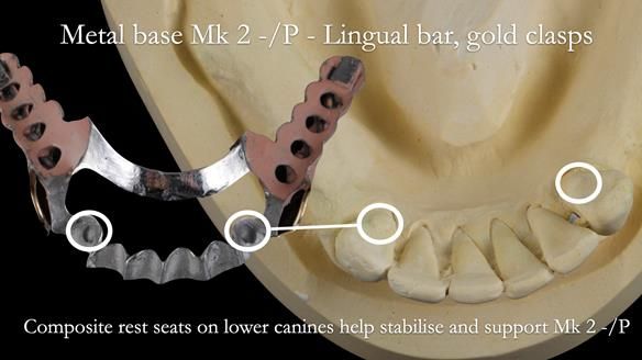 Newsletter 52 Managing Jo’s failing dentition with extractions and Mk 1/Mk 2 complete upper dentures and lower partial dentures FULL PROTOCOL