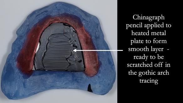 Finlay's Newsletter 62 provision of extractions and metal based complete dentures for Rafique
