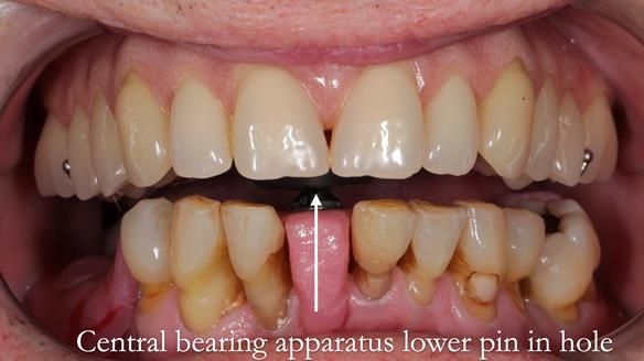 Newsletter 54 case presentation upper complete denture and lower Scandinavian designed hygienic partial denture for David