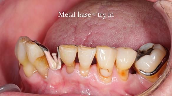 Newsletter 54 case presentation upper complete denture and lower Scandinavian designed hygienic partial denture for David