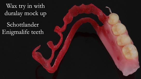 Finlay's Newsletter 61 provision of a lower unilateral free end saddle metal based partial denture for Joyce