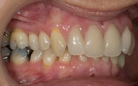 Figure 81 Finished definitive partial dentures with knife edge flanges - replacing the missing gum tissue. Anterior path of insertion to give added retention