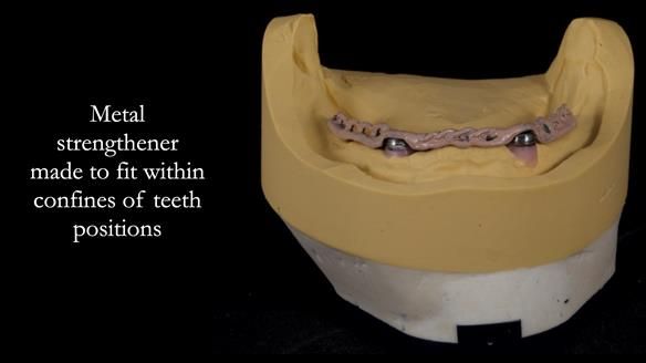 Newsletter 57 showcases the making and fitting process of implant-supported complete dentures for Alisdair