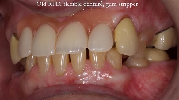 Newsletter 81 - Pam’s Story — how a partial denture changed her life (+ live walkthrough this Thursday)