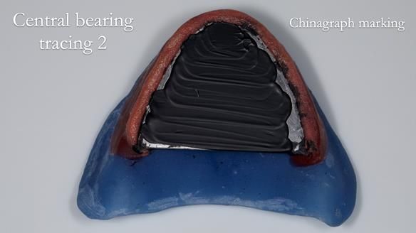 Newsletter 80 - Gordon’s dentures: the one case in 1,000 where my technique failed