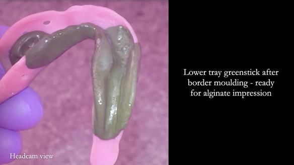 Newsletter 82 Mary - A complete upper and a one-tooth gasket denture