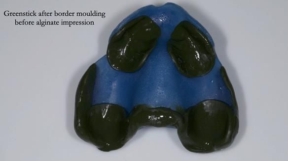 Newsletter 77: Jeremy’s case – immediate complete upper denture