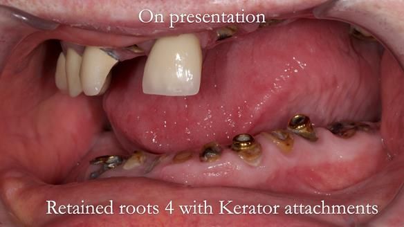 Newsletter 44 - extreme removable prosthodontics – engineering a super-strong and ultra-thin over denture