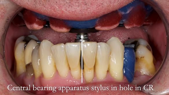 Newsletter 77: Jeremy’s case – immediate complete upper denture