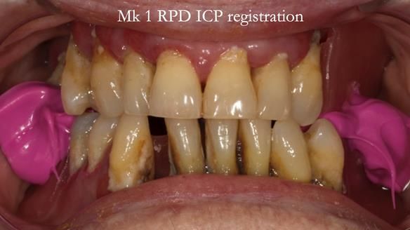 Finlay's Case Study Newsletter 40 - Immediate Mk 1 RPD to Definitive Mk 2 RPD - full protocol