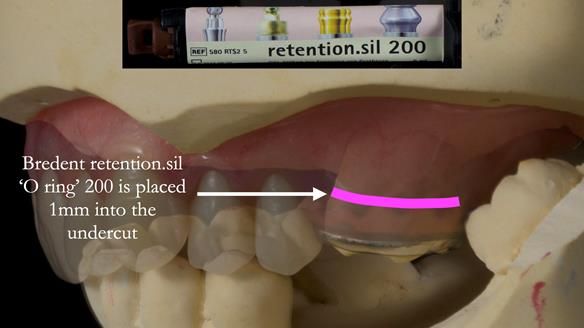 Finlay's Newsletter 58 Gasket upper partial denture for Zoe