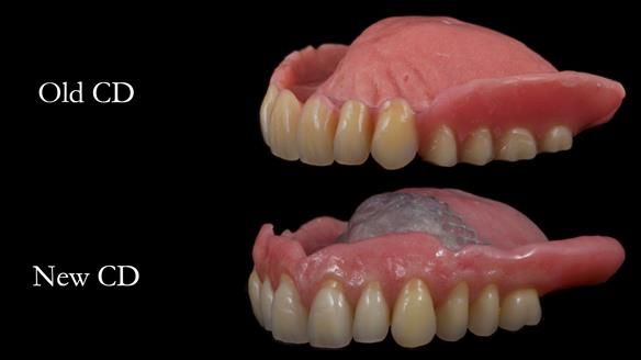 Finlay's Newsletter 62 provision of extractions and metal based complete dentures for Rafique