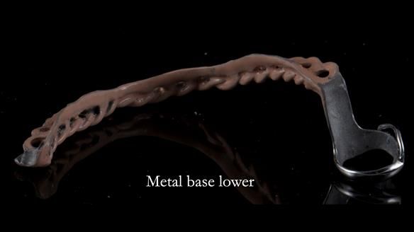 Finlay's Newsletter 59 Ultra hard partial dentures made for Gill