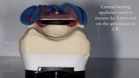 Newsletter 82 Mary - A complete upper and a one-tooth gasket denture