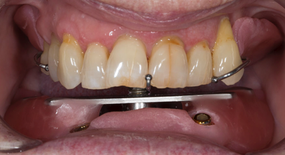 Figure 19 Registration visit with central bearing apparatus (gothic arch tracing) for CR recording