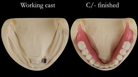 Managing poor implant positioning with complete dentures and Locator attachments - full protocol Newsletter 41