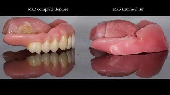 Newsletter 77: Jeremy’s case – immediate complete upper denture