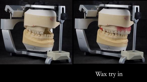 Upper metal base partial denture/occlusal stabilisation splint/obturator - full protocol