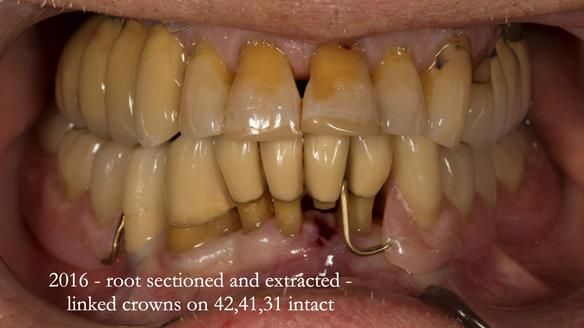 Ken – going downhill, first class