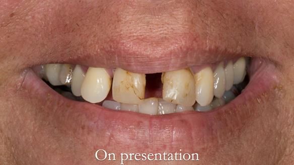 Finlay's Newsletter 63 Case study provision of metal based Scandinavian RPD - functional 10 years on