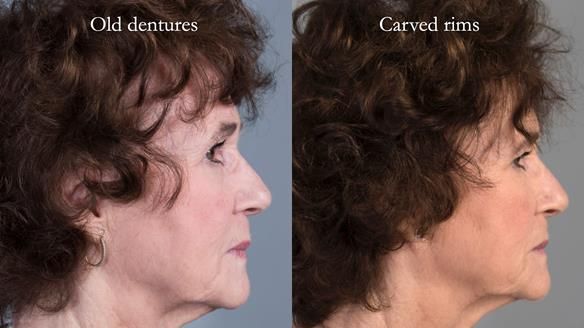Newsletter 75: Marion’s case - Step-by-step complete denture workflow