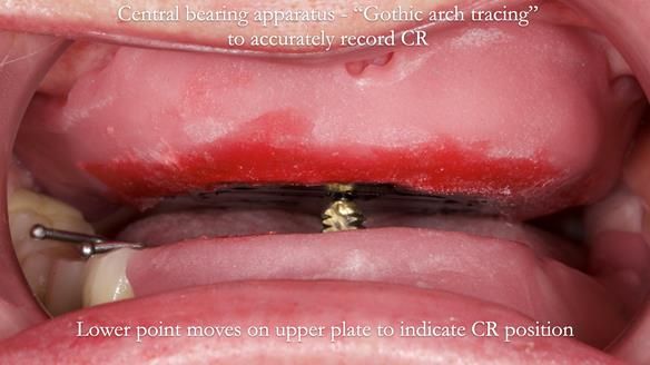 Newsletter 82 Mary - A complete upper and a one-tooth gasket denture