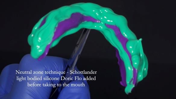 Newsletter 83: Sheila’s Complete Denture Success