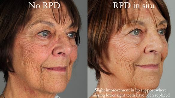 Finlay's Newsletter 61 provision of a lower unilateral free end saddle metal based partial denture for Joyce