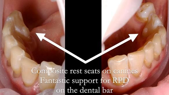 Finlay's Newsletter 61 provision of a lower unilateral free end saddle metal based partial denture for Joyce