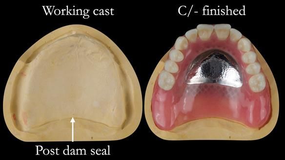 Managing poor implant positioning with complete dentures and Locator attachments - full protocol Newsletter 41