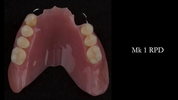 Finlay's Case Study Newsletter 40 - Immediate Mk 1 RPD to Definitive Mk 2 RPD - full protocol